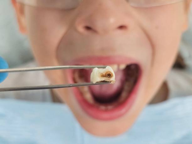 Best Emergency Treatment for Dental Infections or Abscesses in Belgium, WI