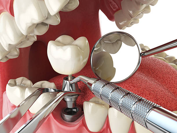 Best Emergency Tooth Extraction in Belgium, WI